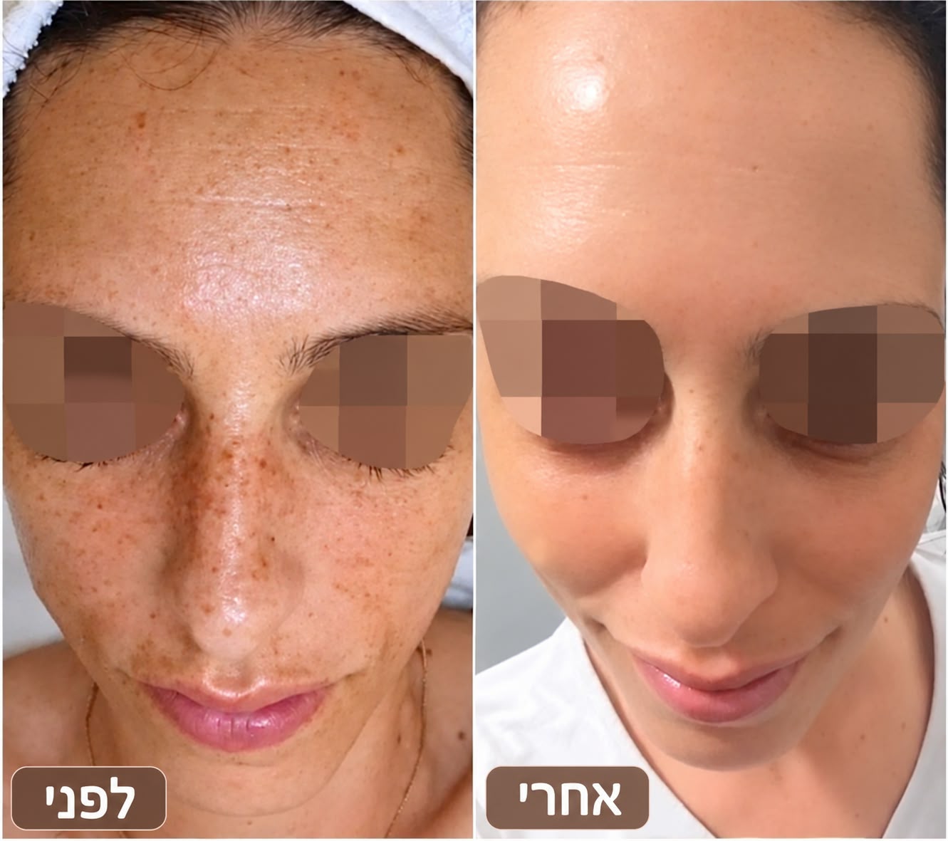 טיפול בפיגמנטציה לפני ואחרי